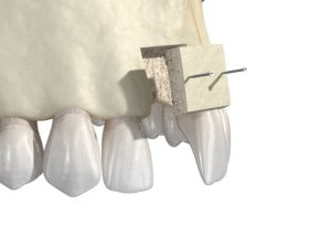 Bone grafting illustration